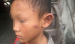 Phẫn nộ dì ruột bạo hành cháu trai 5 tuổi