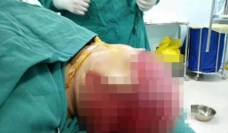 Bị máy giật phăng toàn bộ da đầu vì xõa tóc khi làm việc