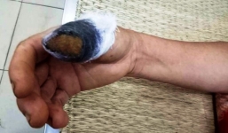 Mâu thuẫn vì hái rau mồng tơi, hai người hàng xóm ẩu đá cắn đứt lìa ngón tay