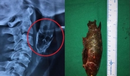 Hy hữu cá sống dài 11cm kẹt trong họng người đi câu