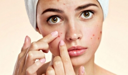 5 thói quen hàng ngày là nguyên nhân khiến bạn mọc mụn