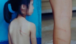 Cô giáo dùng thước đánh bầm tím học sinh lớp 1 vì lười học