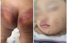 Bình Dương: Người mẹ trẻ tiếp tay cho chồng hờ, bạo hành con trai 2 tuổi phải nhập viện cấp cứu?