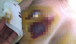 Vụ chi 13.000 USD nâng ngực bị biến chứng: Bộ Y tế vào cuộc