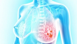 Nữ sinh 19 tuổi mắc bệnh ung thư vú vì thói quen hầu như ai cũng làm