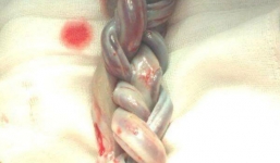 Hạnh phúc mang thai đôi nhưng bác sĩ lại thông báo em bé rất có thể không được chào đời và điều kỳ diệu xảy ra