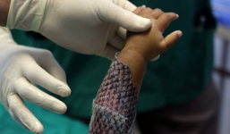 Dùng da cá rô phi để trị bỏng, hiệu quả tốt không ngờ