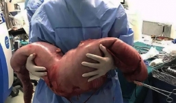 Mổ bụng bệnh nhân, bác sĩ tá hỏa khi phát hiện khối đại tràng dài 76cm do bị táo bón nhiều năm