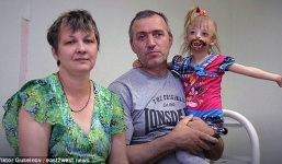 Xót lòng cô bé mắc dị tật 'miệng quỷ' bị mọi người xa lánh