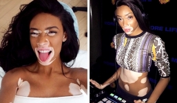 11 người mẫu sở hữu vẻ đẹp xấu lạ làm thay đổi chuẩn mực cái đẹp