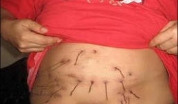 19 năm sống chung với những sợi thép gai mọc từ bụng