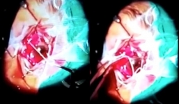 Hãi hùng giun dài 7cm làm tổ trong hốc mắt người phụ nữ