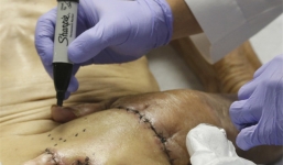 Cụ ông 87 được bác sĩ khâu tay vào bụng và điều kỳ diệu đã xảy ra