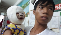 Xót xa trước khuôn mặt biến dạng của bé gái 9 tháng tuổi ngã vào bếp