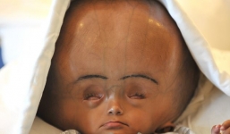 Sau 5 năm chiến đấu, cô bé 'người ngoài hành tinh' đã qua đời