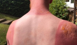 Làm việc ngoài trời nắng suốt 7 tiếng, chàng trai bị bỏng rộp nghiêm trọng