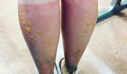 Người phụ nữ bị bỏng nặng vì chạy hơn 100 km dưới trời nắng nóng