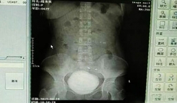 Đi tiểu ra máu, người phụ nữ mới đi khám và phát hiện ra 'quái vật' này trong bụng