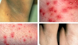 Rước họa vào thân nếu bạn nhổ lông nách bằng nhíp