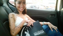 Cô gái có hàng trăm nốt ruồi trên người gạt bỏ mặc cảm đăng kí thi Hoa hậu Hoàn vũ