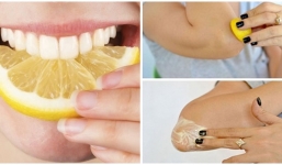 Người bị bỏng kiêng ăn gì để mau lành bệnh