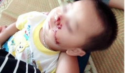 Thực hư chuyện bố say rượu đánh mẹ, vô tình chém rách mặt con trai 2 tuổi