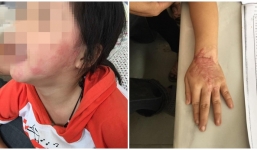 Điện thoại phát nổ khiến bé gái bỏng nặng lúc ngủ, công ty điện thoại phớt lờ