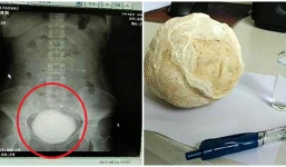 Giật mình khi phát hiện hòn sỏi bàng quang khổng lồ nằm trong bụng người phụ nữ