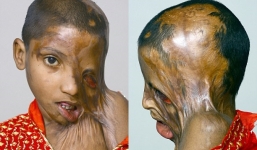 Sự thật đau lòng về gương mặt bị hủy hoại do axit của cô bé 7 tuổi