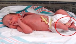 Khi quyết định cắt bỏ chân con gái sơ sinh, chắc người mẹ không dám nghĩ đến tình trạng hiện tại của con