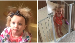 Bé gái tóc luôn dựng đứng vì mắc hội chứng lạ