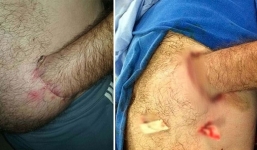 Bác sĩ khâu bàn tay người đàn ông 42 tuổi vào bụng, 42 ngày sau tháo ra hình ảnh thật khó tin