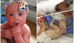 Bé gái mắc chứng bệnh lạ cứ 4 tiếng thay da một lần