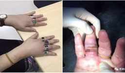Đeo nhẫn đủ 10 ngón tay, người phụ nữ thích khoe của khóc tu tu gọi đội cứu hộ vì không tháo ra được