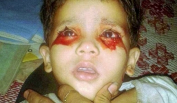 Cô bé 3 tuổi khóc ra máu vì mắc chứng bệnh bí ẩn