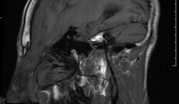 Bệnh lạ khiến não đung đưa trước mặt