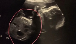 Đi siêu âm thai, cặp đôi bị sốc khi nhìn thấy hình ảnh xuất hiện trên màn hình