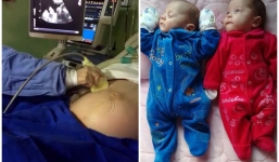 Cặp song sinh chào đời như một phép lạ từ cơ thể người mẹ chết não hơn 4 tháng