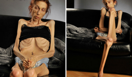 Nữ diễn viên chỉ còn da bọc xương, nhờ cư dân mạng giúp đỡ và điều kỳ diệu đã đến