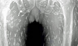 Nghiện ăn sushi, người đàn ông bị sán làm tổ chằng chịt trên khắp người