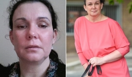 Người phụ nữ 'biến thành người khác' chỉ sau một giấc ngủ vì mắc hội chứng kỳ lạ