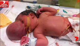 Thai nhi bị 'não mọc ngoài hộp sọ', cặp đôi vẫn quyết định sinh con bỏ ngoài lời khuyên của bác sĩ và kết quả bất ngờ