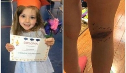 Phát hiện con gái có vết bầm ở chân, bố mẹ tá hỏa khi biết sự thật