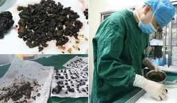 Những thứ được lấy ra từ bụng bệnh nhân khiến bác sĩ không tin nổi, số 1 quá đáng sợ