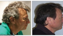 Bất ngờ bệnh nhân dùng thuốc ung thư mới làm chuyển màu tóc