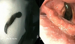 Gia Lai: Hãi hùng con vắt dài 10cm nằm trong khí quản bệnh nhân