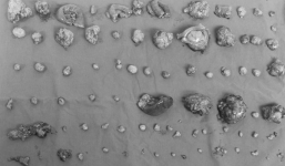 Hãi hùng nam bệnh nhân có 100 khối u trong bụng