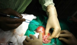 Hy hữu bé trai 'mang thai' em song sinh 