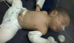 Hy hữu chuyện bé trai mới ra đời đã 'mang thai' người anh em song sinh
