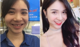 Thanh Bi “Người phán xử” bất ngờ bị tung ảnh trước khi làm răng